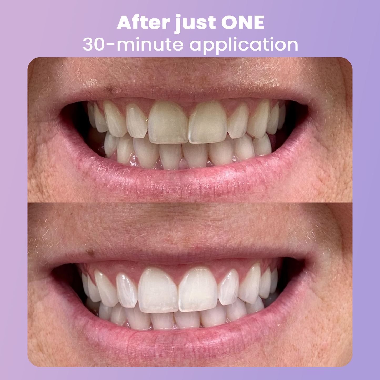 PEARLFECT Color-Correcting Whitening Strips